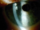 Why Femto-phaco may not be ready for prime time