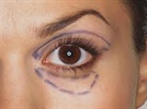 Considerations in Blepharoplasty Surgery