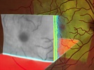 FastTrac™- The NEW retinal tracking system with CIRRUS™ HD-OCT