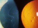 Pearls for the Management of Anterior Basement Membrane Dystrophy of the Cornea