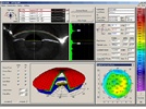 Update on Surgical Correction of Astigmatism