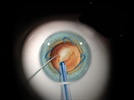 Pearls for Treating IFIS