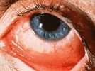 A Potent Broad-spectrum Fluoroquinolone for the Treatment of Bacterial Conjunctivitis
