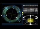 The Top 10 Ophthalmology Technology Highlights from ASCRS 2013