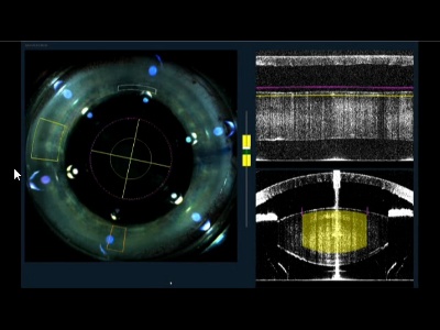 The Top 10 Ophthalmology Technology Highlights from ASCRS 2013