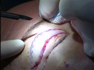 Pearls for Blepharoplasty