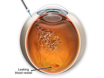 New Perspectives on Macular Degeneration Therapies