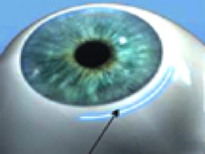 A Change in Thinking: Do Not Enlarge the Cataract Wound When Things Go Downhill