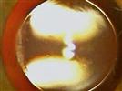 Dizzy After Cataract Surgery:  An Interactive Case