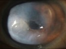 The Cloudy Cornea:  A Case Report
