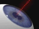 Femtosecond Laser Cataract Surgery