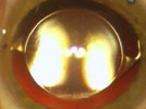 Astigmatism and Cataract Surgery