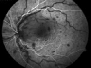 Doheny Grand Rounds: Factor V Leiden, Simultaneous CRVO and BRAO