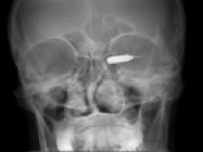 Eyelid and Orbital Implant Injury After Enucleation