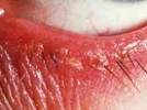 Blepharitis Revisited