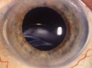 Capsular Tension Rings:  A Short- or Long-Term Solution?