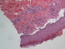 Doheny Resident Clinical Conference:  Stevens-Johnson Syndrome