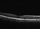 What Does FD-OCT Have to Offer for Glaucoma?