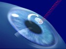 Is Lasik Dead?