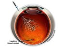 Intravitreal Injections:  How You and Your Patient Can Sleep Well