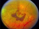 Does Cataract Surgery Promote the Development of Wet Age-Related Macular Degeneration (AMD)?