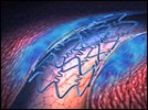 IOLs Expand Patients’ Vision, Ophthalmologist Choices