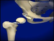 Ultra-Fast Laser Increases LASIK Surgery Precision