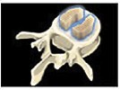 Perfluorocarbons in Intravitreal Surgery