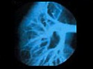 Ophthalmic Microsurgery with Surgical Loupes