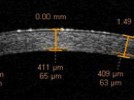 Corneal Pachymetry:  Modalities and Instruments