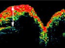 Advances in Optical Coherence Tomography (OCT)