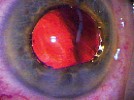 Management of IFIS (Intraoperative Floppy Iris Syndrome)