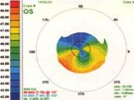 Instrument Basics Part III:  Corneal Curvature