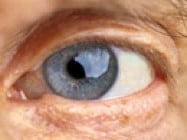 Visual Testing for Cataracts