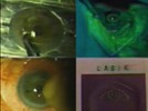 The Right Decision: Accurate and Effective Preoperative Evaluation of LASIK Candidates