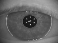 Cataract Surgery:  Improving Outcomes