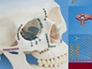 Management of Orbital Fractures