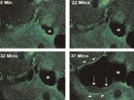 Predicting and Improving the Outcomes of SLT Therapy
