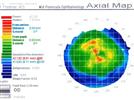 Unusual Corneal Topography:  A Case Report