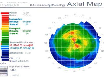 Unusual Corneal Topography:  A Case Report