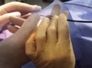Minimally Invasive Glaucoma Surgery (MIGS)