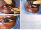 Treating Epiphora Part One: Diagnosis and Solutions from FCI