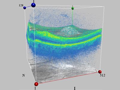 3-D in Ophthalmology