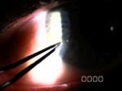 Fiber Removal without Flap Displacement
