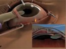 The TAN EndoGlide™ Endothelial Insertion System