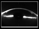 Topic 3: Other Clinical Uses of the Pentacam: Cataract, Glaucoma, Cornea