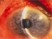 The first day after trabeculectomy, a patient with primary open angle glaucoma presents with a bleb that is almost flat, a very shallow anterior chamber, and vision decreased from 20/30 to 20/100.  The IOP is 1 to 2 mmHg.  What is the most likely cause?