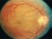 This post operative clinical picture is most likely to be seen in which of the following patients following trabeculectomy?