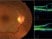 The images below are most consistent with which diagnosis?
