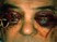 The man in the photo below was seen 6 hours after trauma.  His vision is CF ou, he has a left RAPD and his IOP is 50mmHg.  What should be your first line of therapy?